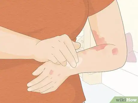 Image titled Use Aloe Vera to Treat Eczema Step 1