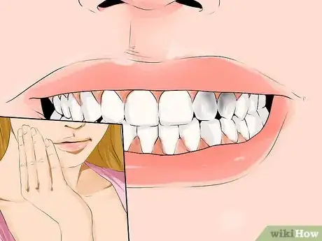 Image titled Prepare for a Cavity Filling Step 2