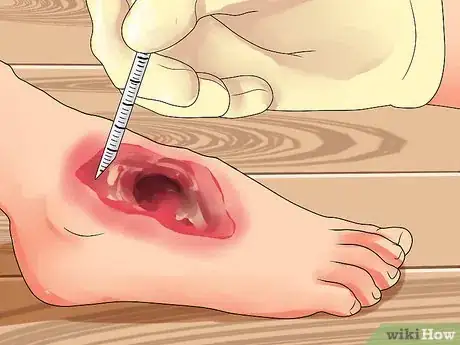 Image titled Measure Wound Granulation Step 3