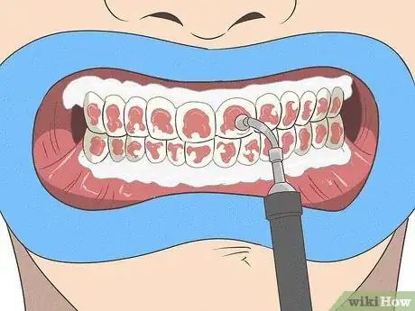 Image titled Fix Nicotine Stained Teeth Step 8