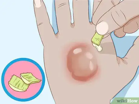 Image titled Get Rid of Poison Ivy Rashes Step 13