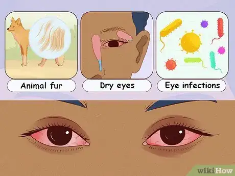 Image titled Stop Your Eye from Itching Step 5