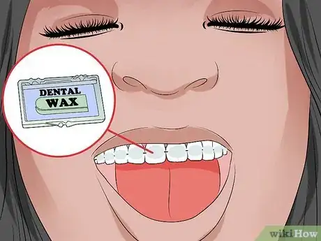 Image titled Stop Fiddling with Your Braces Step 11