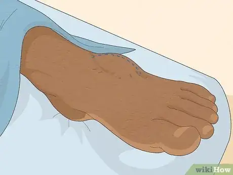 Image titled Know if You Have Neuropathy in Your Feet Step 17