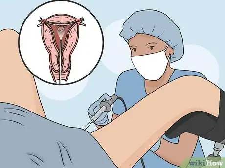 Image titled Remove Uterine Polyps Step 01