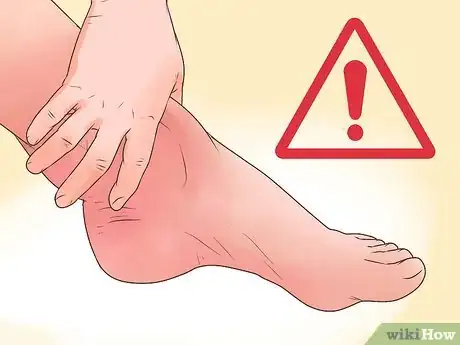 Image titled Cure a Swollen Ankle Step 17