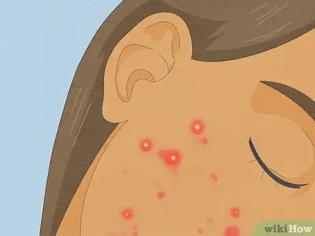 Image titled Tell if Acne Is Hormonal or Bacterial Step 13