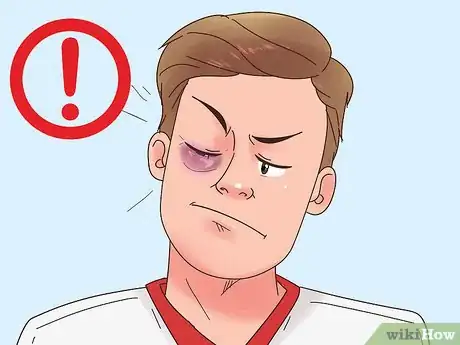 Image titled Get Rid of a Black Eye Step 3