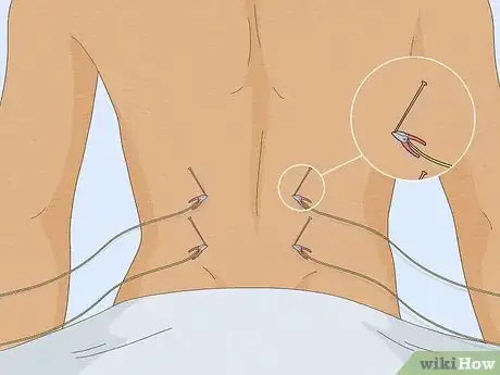 Image titled Ease Constipation with Acupuncture Step 7