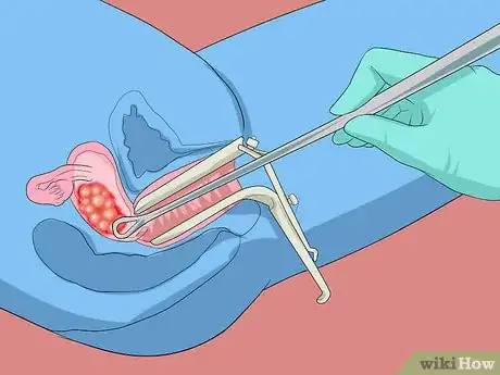 Image titled Prevent Molar Pregnancy Step 6