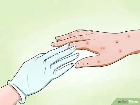 Image titled Avoid Getting Chicken Pox While Helping an Infected Person Step 5