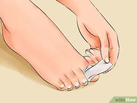 Image titled Remove an Ingrown Toenail Step 17