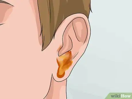 Image titled Know if You Have Otitis Media Step 3