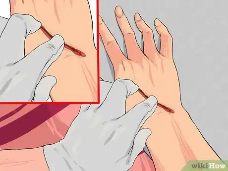 Image titled Apply First Aid without Bandages Step 12