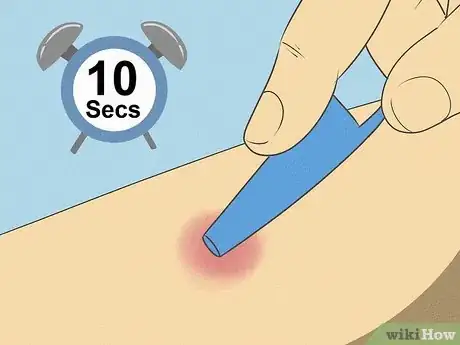 Image titled Get Rid of a Mosquito Bite Step 10