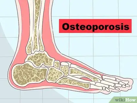 Image titled Identify a Stress Fracture Step 8