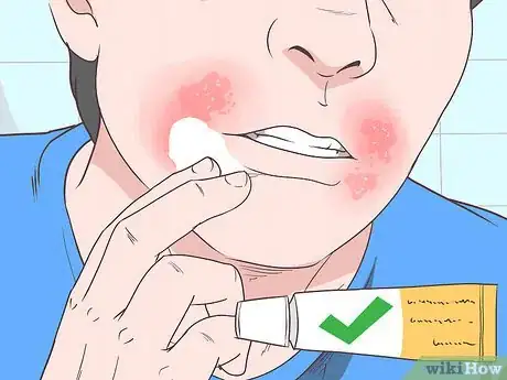 Image titled Treat Perioral Dermatitis Step 2