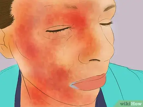 Image titled Treat Pimples with Fucidin Step 7