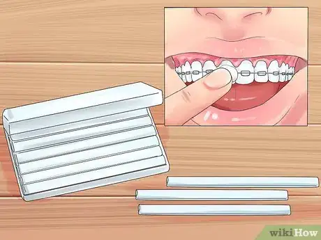 Image titled Alleviate Orthodontic Brace Pain Step 10