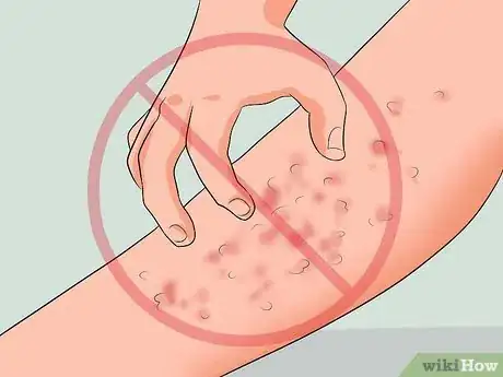 Image titled Get Rid of a Rash from Nair Step 8