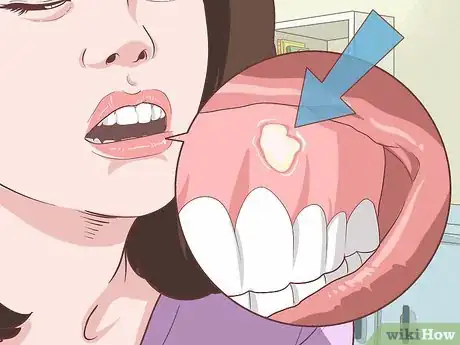 Image titled Relieve Gum Pain Step 1