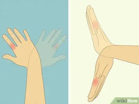 Image titled Know If Your Knuckle Is Broken Step 11