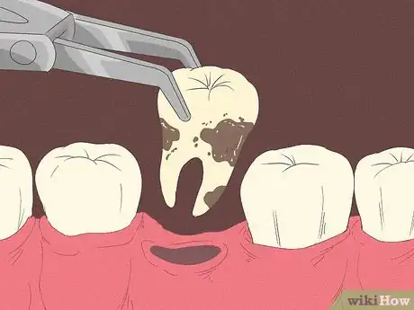 Image titled Get Rid of Tooth Pain Step 20