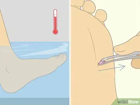 Image titled Get Glass out of Your Foot Step 5