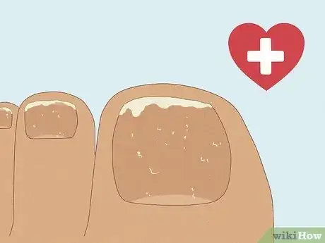 Image titled Fix a Split Toenail Step 11