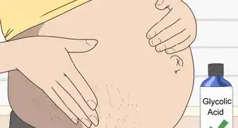 Minimize Stretch Marks During Pregnancy