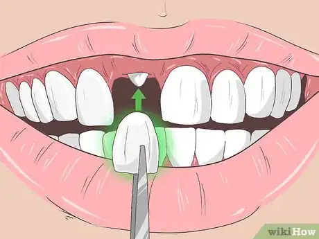 Image titled Remove Brown Stains from Teeth Step 10