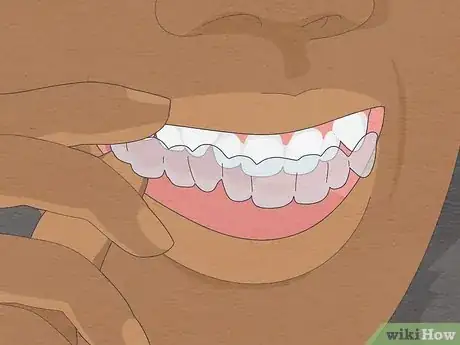 Image titled Straighten Your Teeth Without Braces Step 11