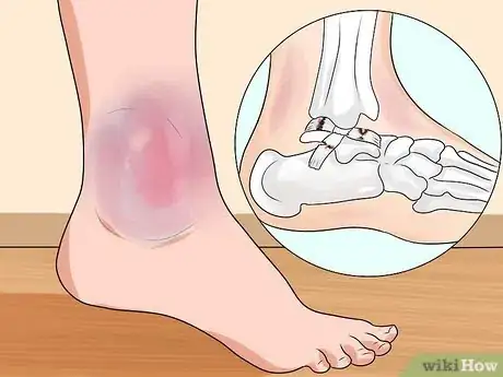 Image titled Know if You've Sprained Your Ankle Step 7