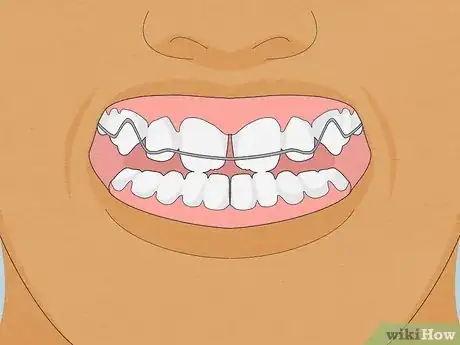 Image titled Straighten Your Teeth Without Braces Step 14