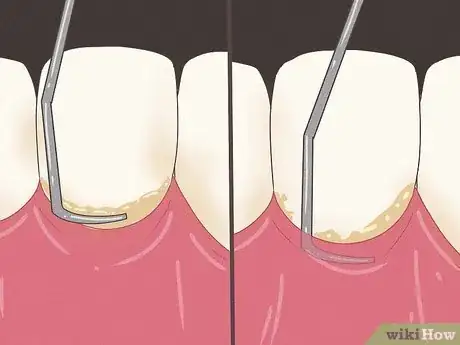 Image titled Stop Itchy Gums Step 14