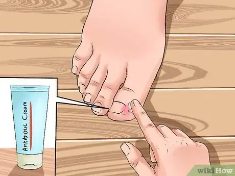 Image titled Avoid Ingrown Toenails Step 8