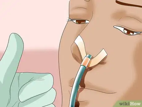 Image titled Insert a Nasogastric (NG) Tube Step 15