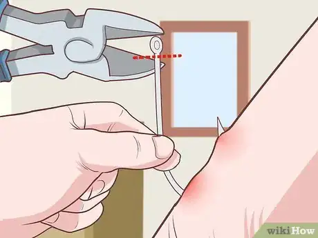 Image titled Remove a Fishhook from Skin Step 16