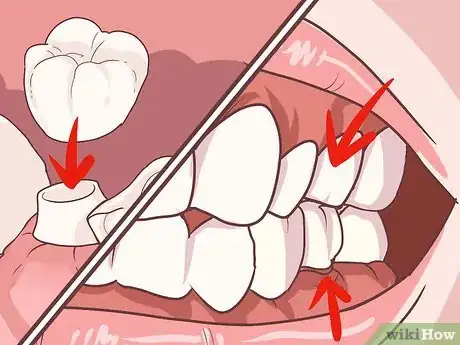 Image titled Fix a Lost Dental Crown Step 8