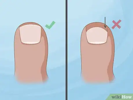 Image titled Prevent Ingrown Nails Step 2