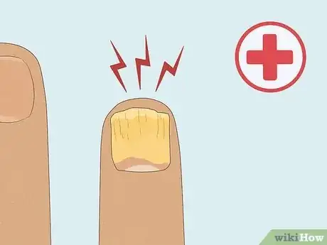 Image titled Cure Nail Fungus Step 9