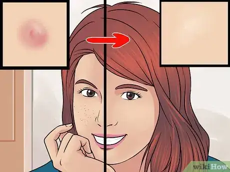 Image titled Prevent Acne Scars Step 11