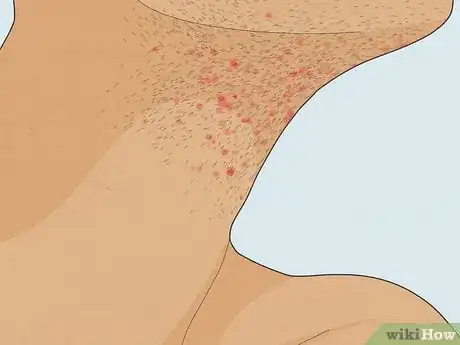 Image titled Should You Shave Your Face Step 5