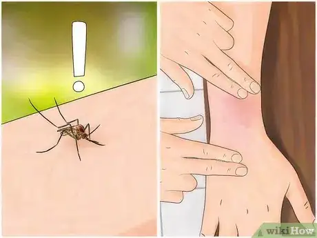 Image titled Soothe a Mosquito Bite Step 15