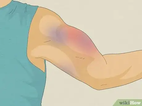 Image titled Know if Left Arm Pain Is Heart Related Step 11