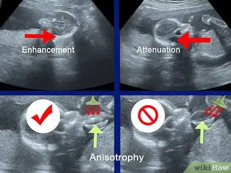 Image titled Read an Ultrasound Picture Step 4