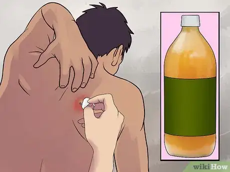 Image titled Remove a Sebaceous Cyst Step 8