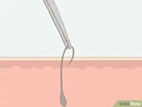 Image titled Get Rid of Ingrown Pubic Hair Step 9