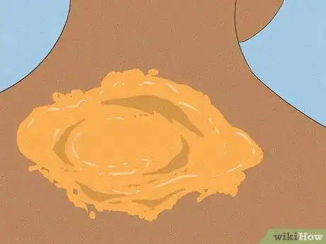 Image titled Remove Sunburn Patches (for Indian Skin Types) Step 3