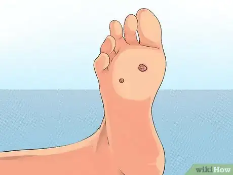 Image titled Get Rid of Plantar Warts (Verrucas) Step 12